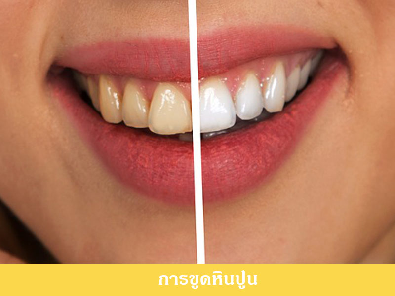 ขูดหินปูน ควรทำเมื่อไหร่!