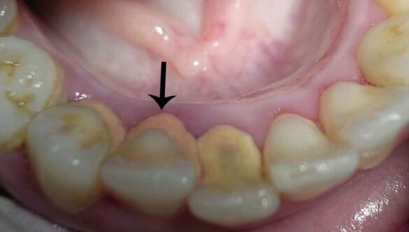 คราบหินปูน ในช่องปาก ต้นเหตุของโรคเหงือกและฟัน