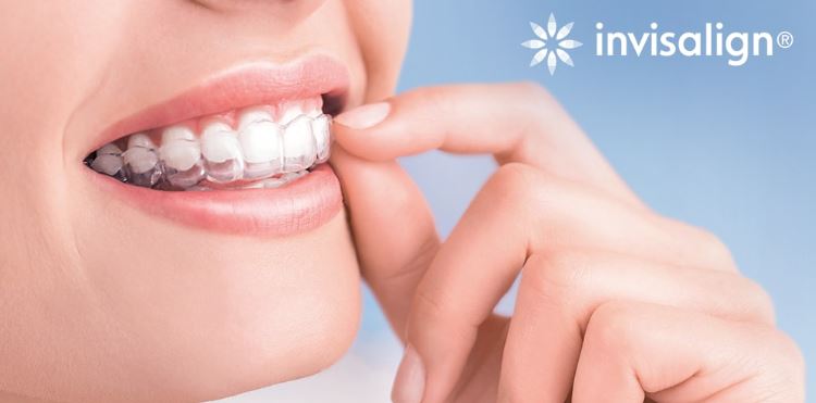 การจัดฟันใสแบบ Invisalign