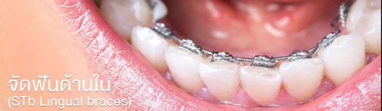 การจัดฟันด้านในแบบไม่เห็นเครื่องมือ (STb Lingual braces)