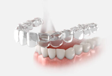 Transparent retainer fixed on lower jow.