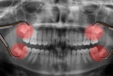display four wisdom teeth over x-ray