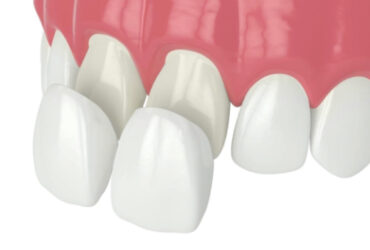 Veneer วีเนียร์