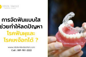 การจัดฟันแบบใส ช่วยทำให้ลดปัญหาโรคฟันผุและโรคเหงือกได้