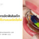 หลังจากการจัดฟันในเด็ก ต้องสวมใส่รีเทนเนอร์หรือไม่